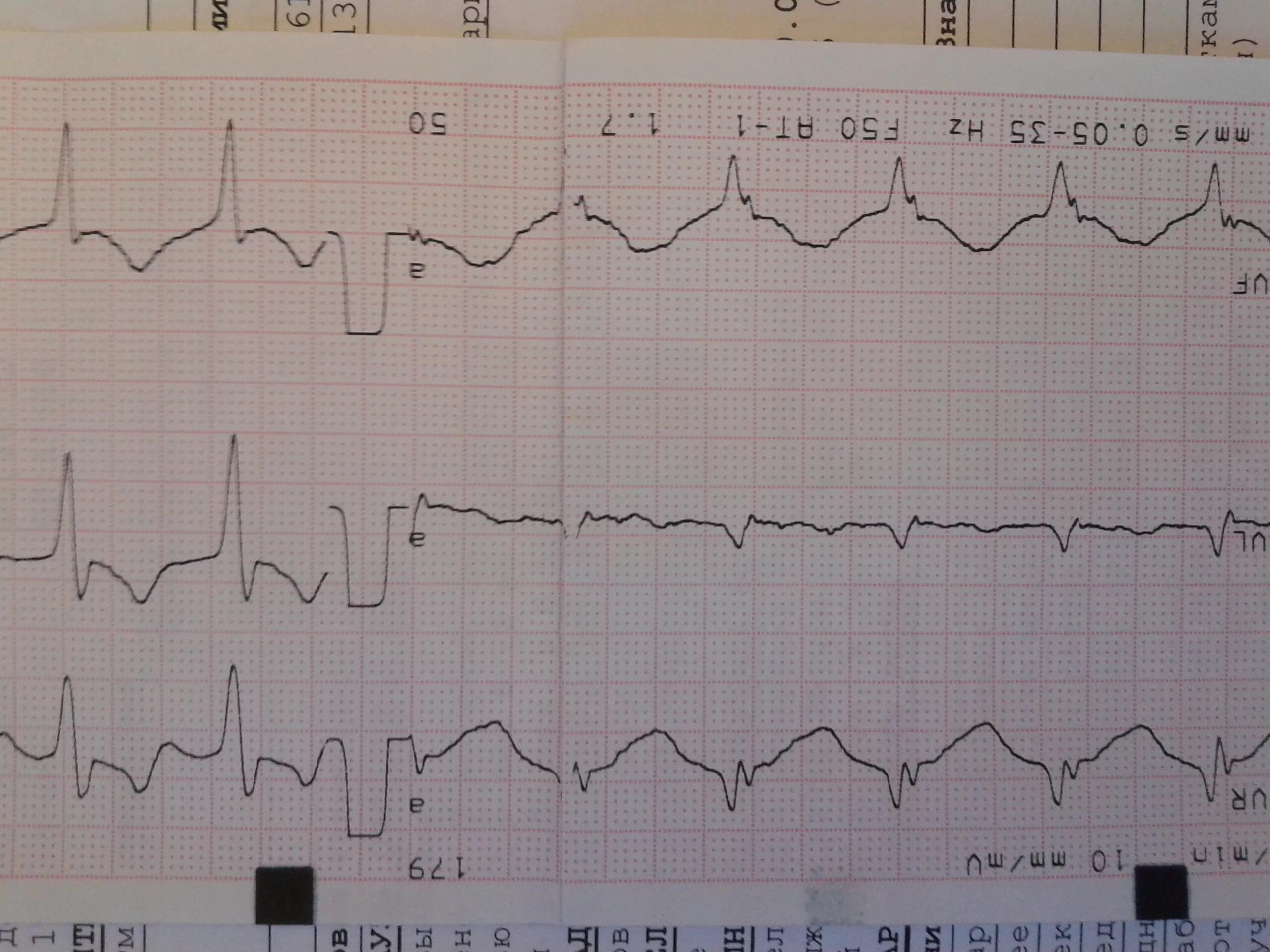 Тахикардия 3. Аритмия и сердечная недостаточность. Кардиограмма сердца тахикардия. Тахикардия 3. Ритм синусовый.