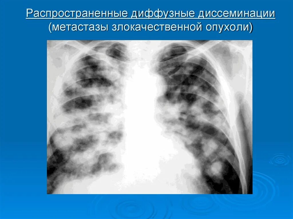 Крупноочаговый диссеминированный туберкулез рентген. Синдром диффузной диссеминации рентген. Синдром легочной диссеминации рентген. Синдром диффузной диссеминации в легочном поле. Диффузный рак легких