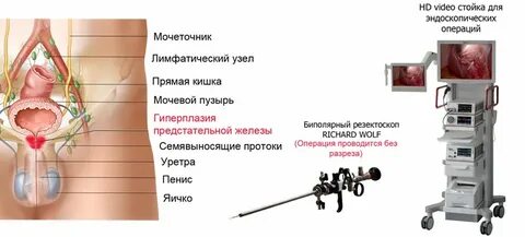 Отзывы мужчин после операции аденомы простаты