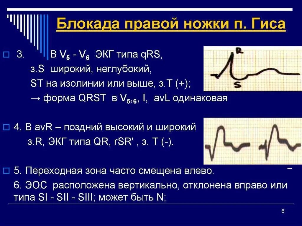 Блокада qrs. Нарушение проводимости блокады ЭКГ. ЭКГ при нарушении проводимости (блокады). Внутрижелудочковая блокада на ЭКГ. ЭКГ при нарушении желудочковой проводимости.