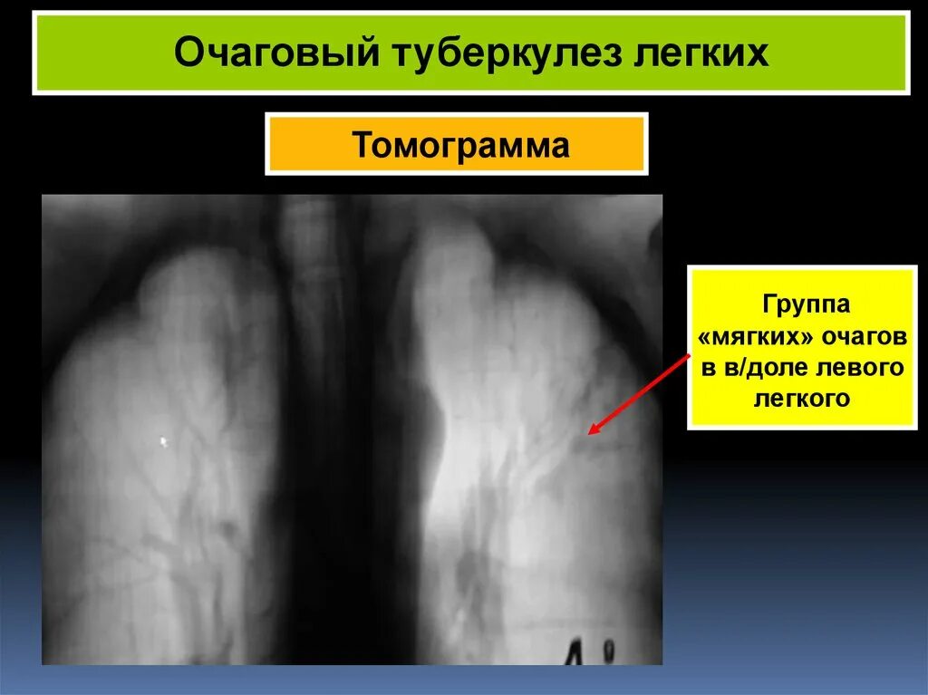 Фазы очагового туберкулеза