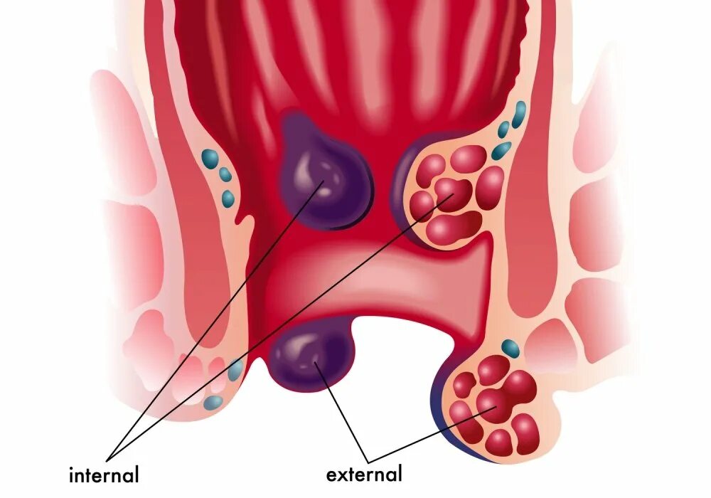 Геморрой у мужчин причины возникновения и лечение. Наружный геморрой 3 степени. Внутренний тромбированный геморрой. Тромбированный наружный геморроидальный узел.