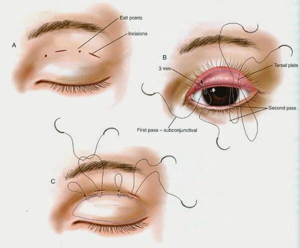 Как вывернуть веко. Сангапури. Операция сангапури. Блефаропластика-сангапури (сингапури). Блефаропластика верхних век схема.