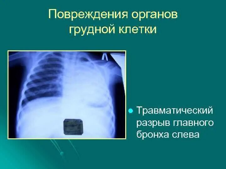 Закрытые травмы грудной клетки классификация. Травматические повреждения грудной клетки. Травматические повреждения грудной клетки. Травматические повреждения грудной клетки. Закрытая травма грудной клетки.