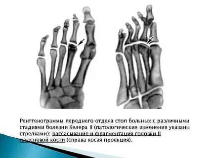 Болезнь келлера 2 степени