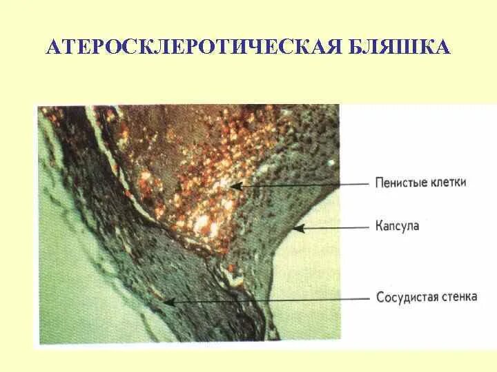 Что такое атеросклеротические бляшки. Атеросклеротическая бляшка. строение атеросклеротической бляшки. атеросклеротическая бляшка состоит из.