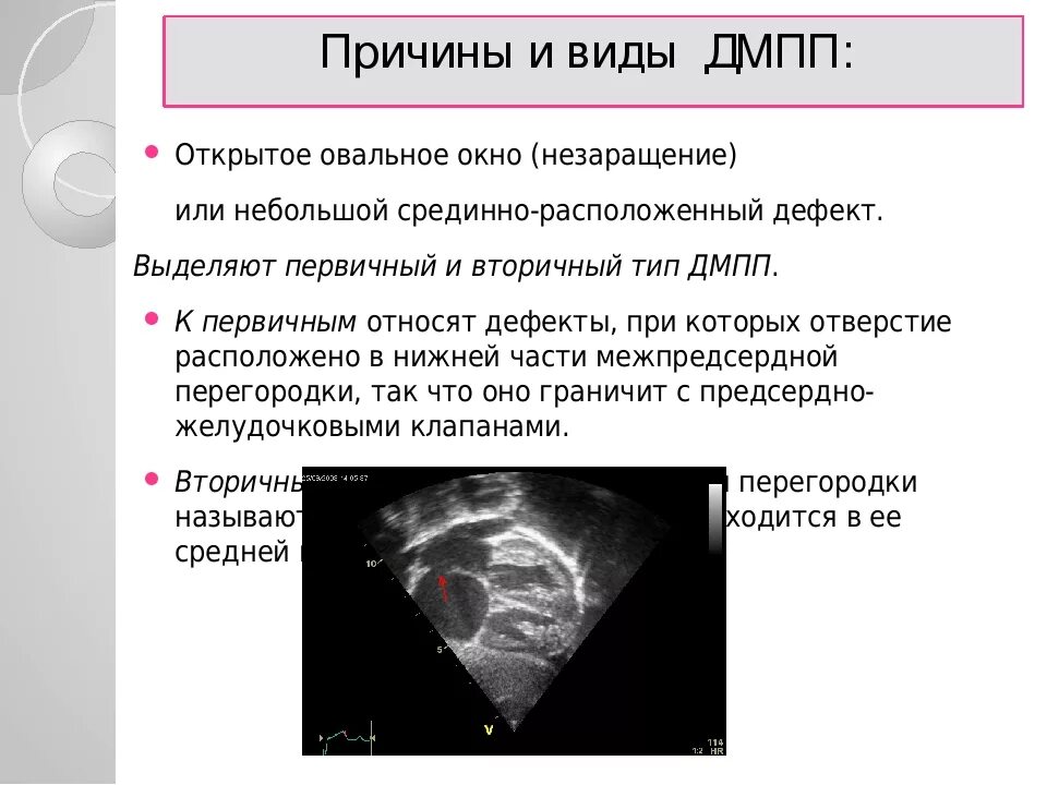 Функционирующее овальное. Порок сердца незаращение овального окна. Открытое овальное окно в сердце у взрослого на УЗИ. УЗИ сердца открытое овальное окно у грудничка. Открытое овальное окно эхокардиография заключение.