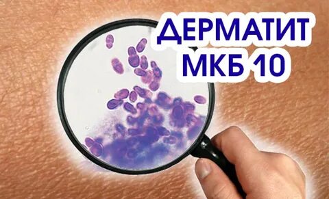 Аллергодерматит мкб 10