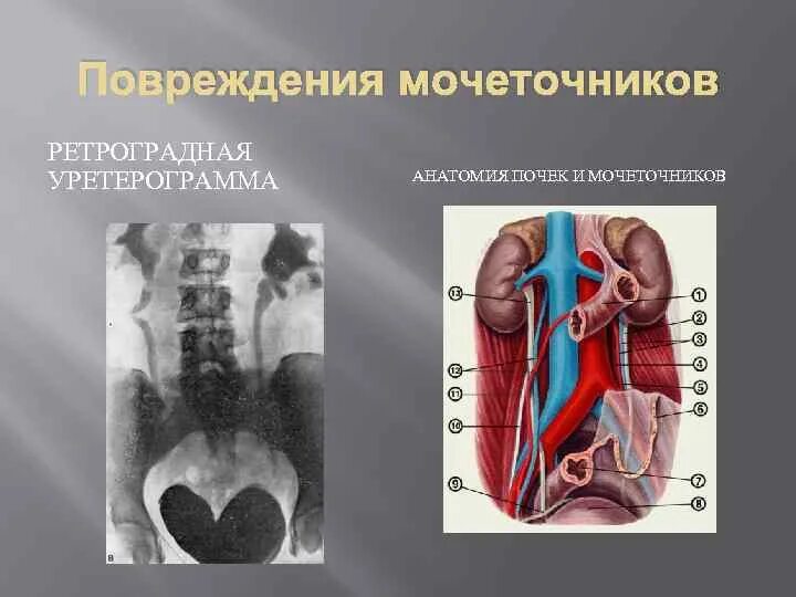 Травма мочеточника. Повреждение мочеточника. Повреждениях мочеточника и почки. Травма мочеточника классификация.