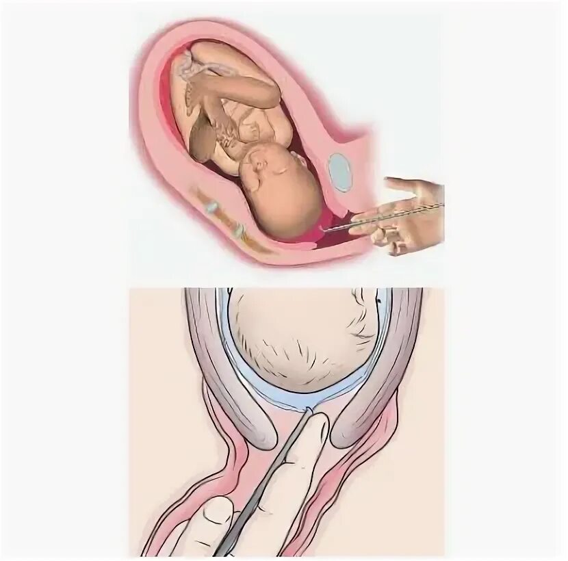 Схватки после прокола. Амниотомия (вскрытие плодного пузыря). Прокол пузыря амниотомия плодного. Пролабирование плодного пузыря. Показания к вскрытию околоплодного пузыря.