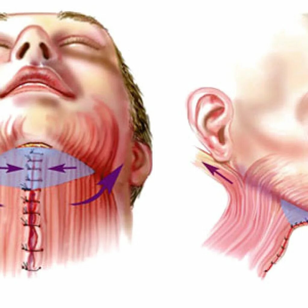 Почему сводит лицо. Медиальная платизмопластика. Латеральная платизмопластика пластика шеи. Смас платизмопластика. (Медиальная/ латеральная) платизмопластика шеи.