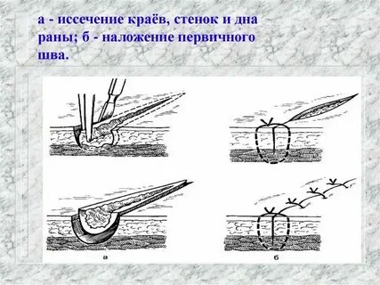 Реабилитация после иссечения трещины