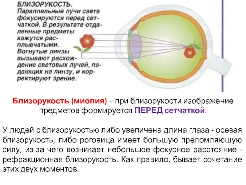 У близоруких людей изображение фокусируется перед сетчаткой. Близорукость. Близорукость глаз. Близорукость лучи света фокусируются. Близорукость миопия.