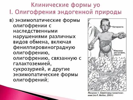 Олигофрения признаки