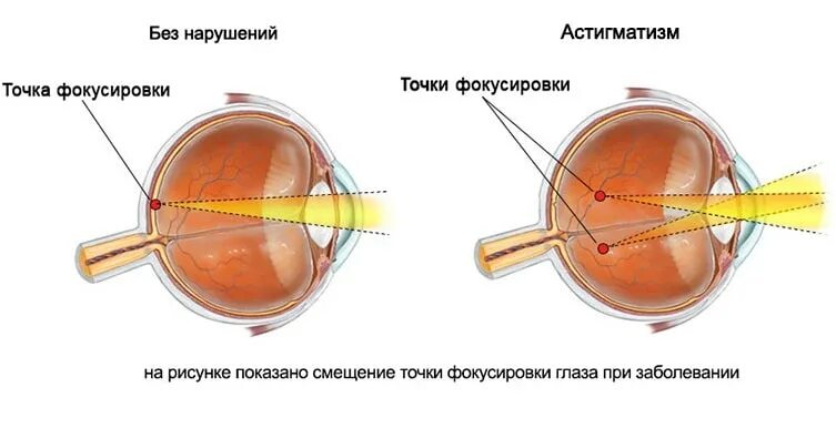 Точка лежащая зрение. Строение глаза человека астигматизм. Болезни глаз дальнозоркость близорукость. Миопия гиперметропия астигматизм. Заболевание органов зрения миопия.