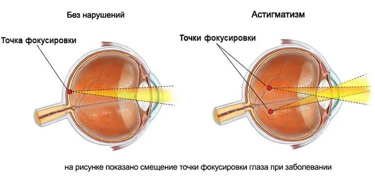 Улучшение зрения дальнозоркость. Строение глаза человека астигматизм. болезни глаз дальнозоркость близорукость. миопия гиперметропия астигматизм. заболевание органов зрения миопия.
