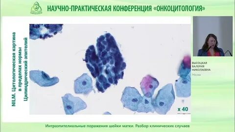 Плоское интраэпителиальное поражение