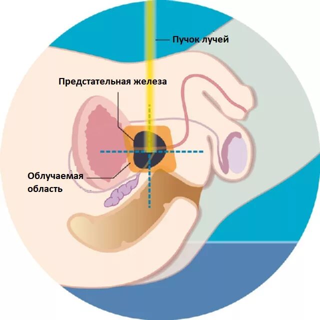 Простата действий. Дучевая тераптяпредстательной железы. Лучевая терапия предстательной железы. Лучевая терапия при онкологии простаты.