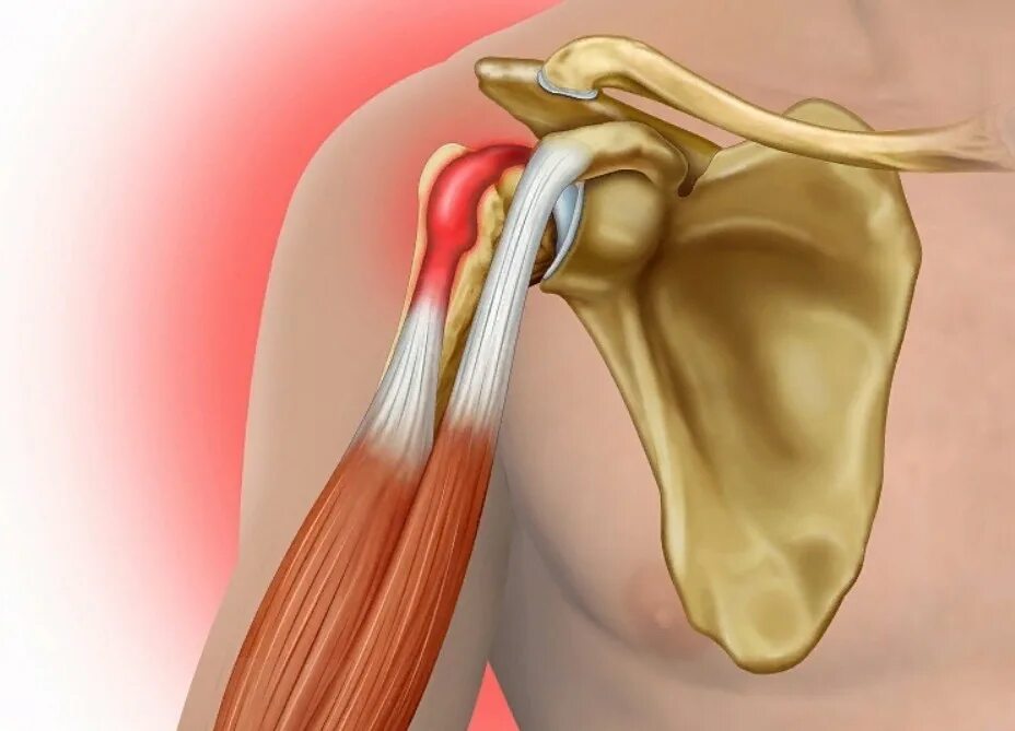 Сухожилия плеча. Тендинит длинной головки бицепса плеча. Разрыв сухожилия плечевого сустава. Тенодез длинной головки.