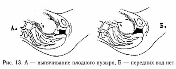 Сколько роды после прокола пузыря. Прокол околоплодного пузыря. Выпячивание плодного пузыря.