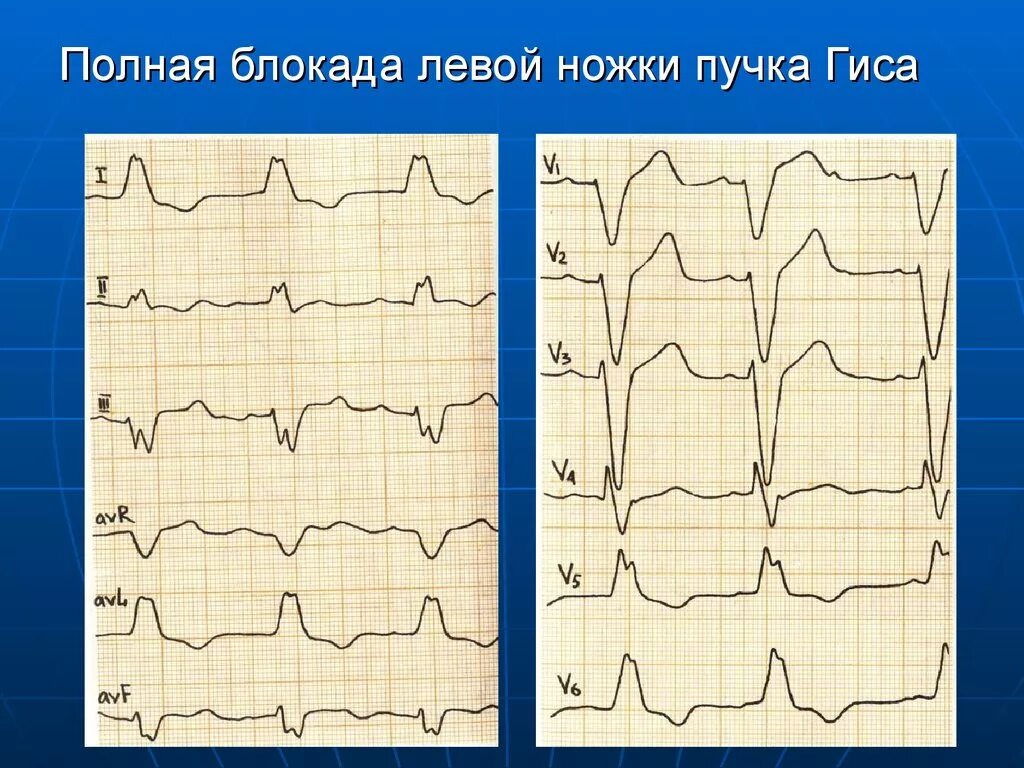 Что значит блокада левой ножки пучка гиса. Полная блокада ЛНПГ на ЭКГ. Полная блокада левой ножки пучка Гиса на ЭКГ. Полная блокада левой ножки Гиса на ЭКГ. Блокада левой ножки пучка Гиса на ЭКГ.