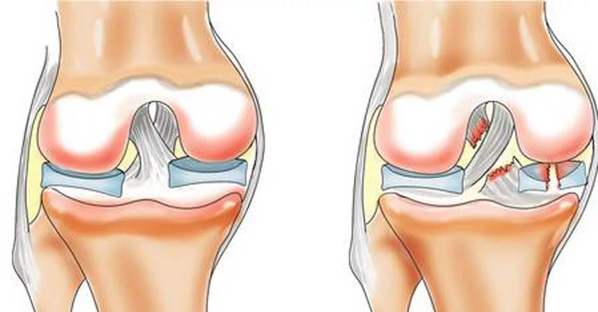 Болит ли мениск. Разрыв мениска коленного сустава. Травма мениска коленного сустава. Отрыв мениска коленного. Менископатия коленного сустава.