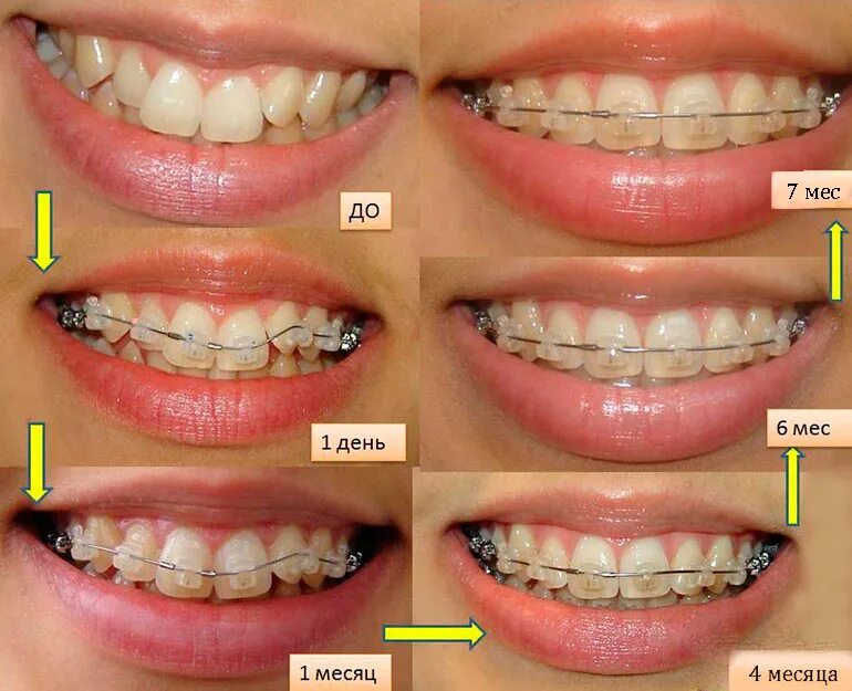 Можно ли через месяц. Безлигатурные брекеты h4. До и после ношения Брек тов. Ровные зубы после брекетов.