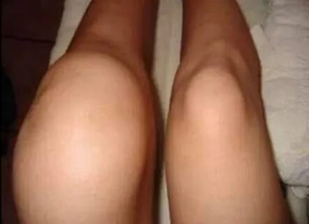 Отекли ноги после массажа