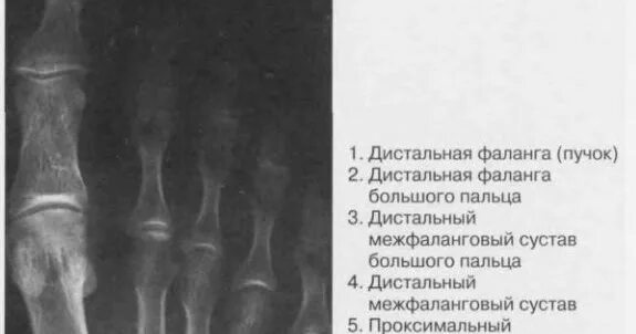 5 фаланга стопы. Остеомиелит дистальной фаланги 1 пальца. Дистальная фаланга большого пальца стопы. Остеомиелит ногтевой фаланги 1 пальца кисти. Остеомиелит ногтевой фаланги рентген.