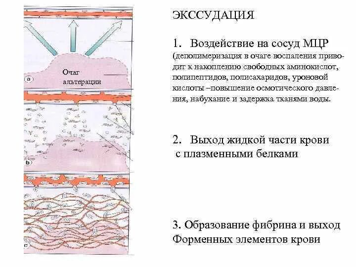 Экссудация патанатомия. Стадии экссудации воспаления. Воспаление альтерация экссудация пролиферация. Этапы экссудации. Экссудация возникает вследствие