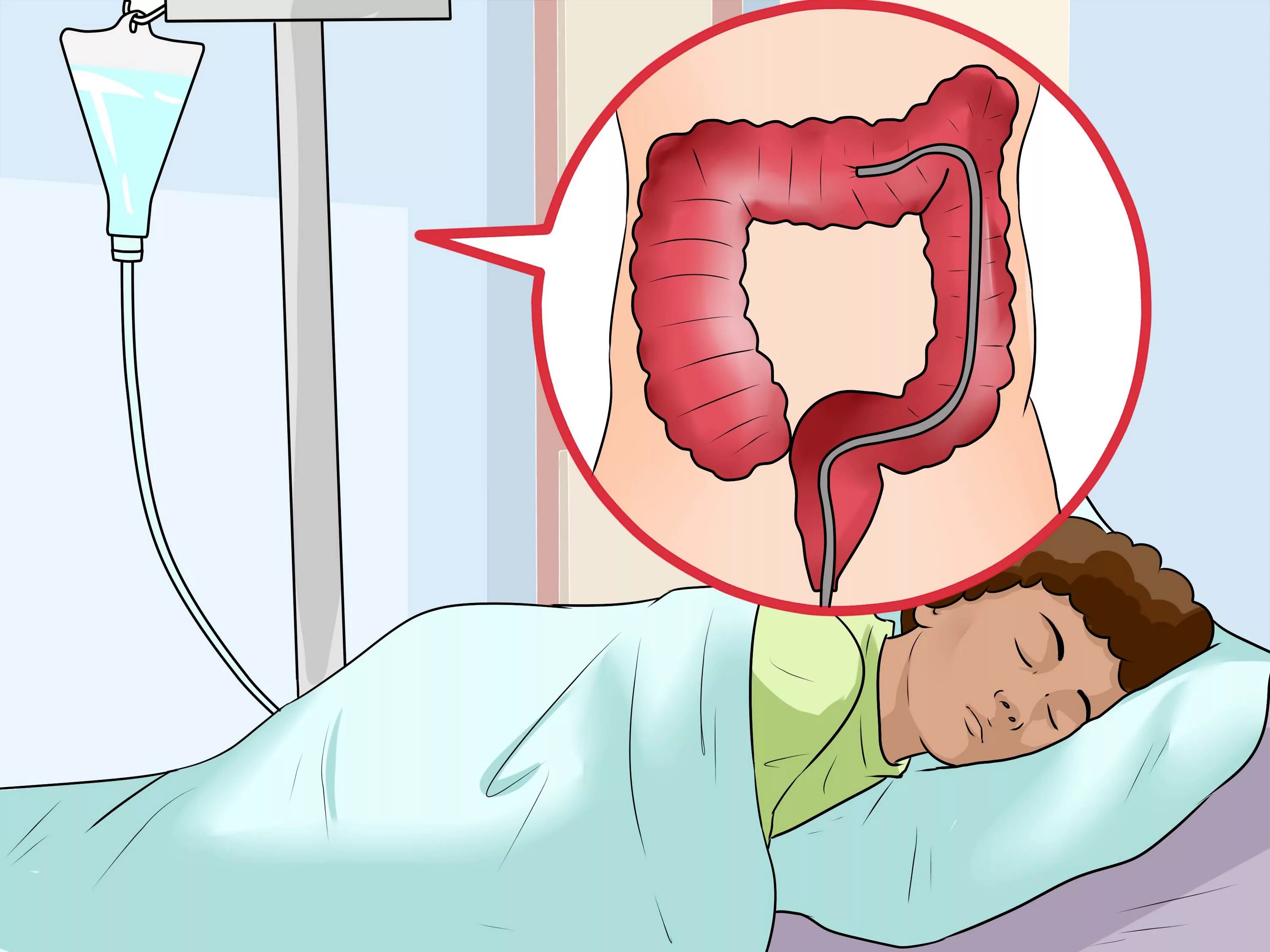 Ирригоскопия ребенку 5 лет. Ирригоскопия кишечника. Ирригоскопия колоноскопия. Как правильно вставить кишку