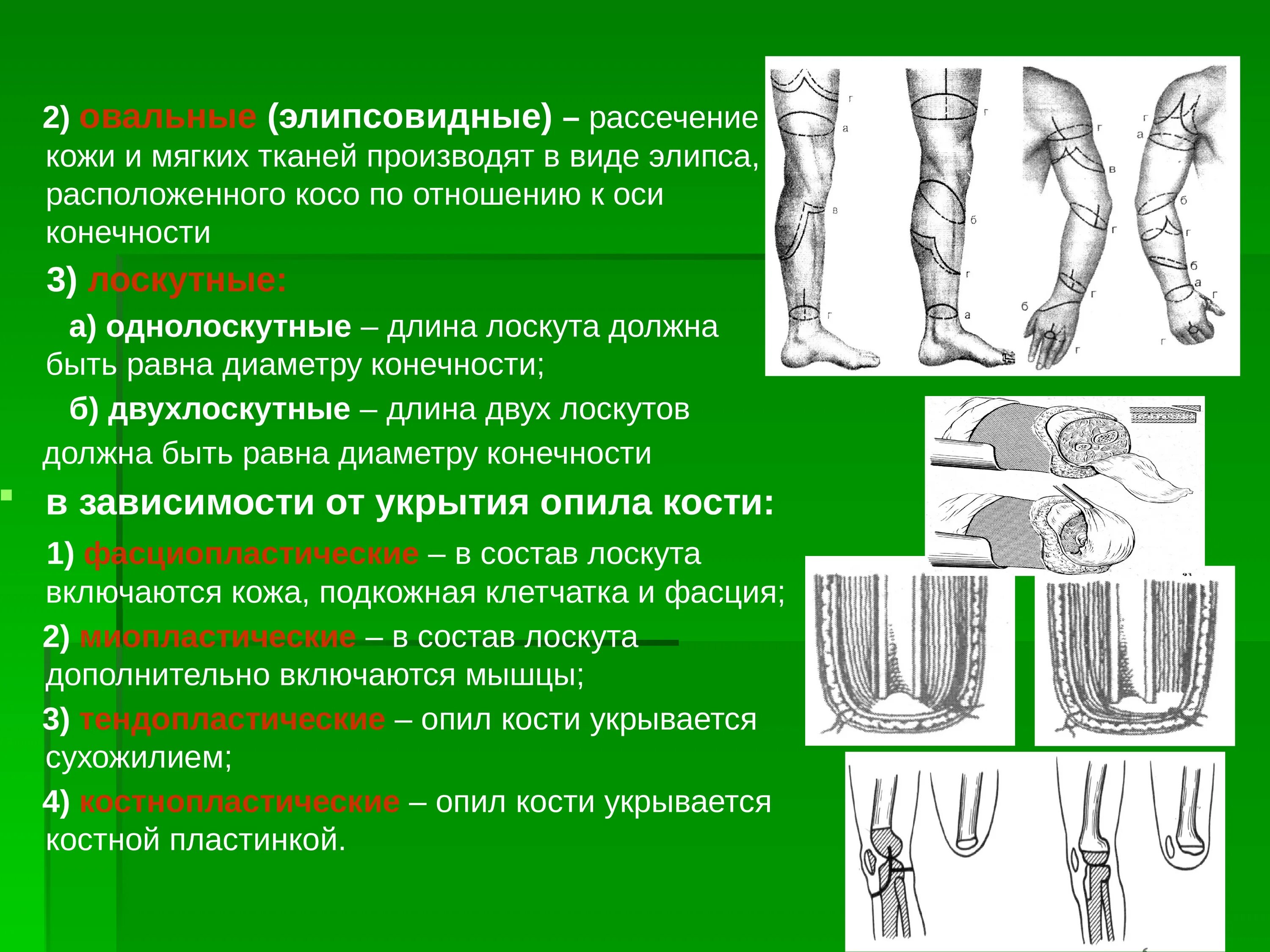 Классификация ампутация по способу усечения мягких тканей. Экзартикуляция верхней конечности. Классификация ампутаций по способу нанесения кожного разреза. Классификация ампутаций по форме рассечения мягких тканей.