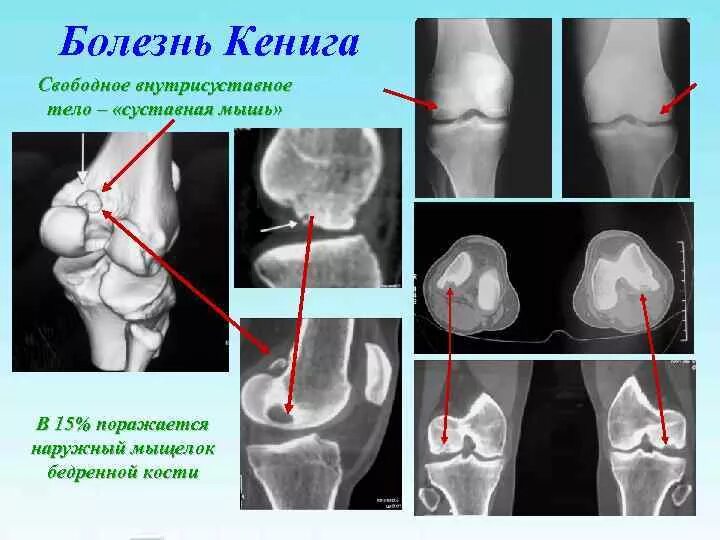 Хондромаляция мыщелков. Рассекающий остеохондрит коленного сустава рентген. Остеохондропатия бедренной кости Кенига. Болезнь Кенига коленного сустава кт. Рассекающий остеохондрит надколенника кт.