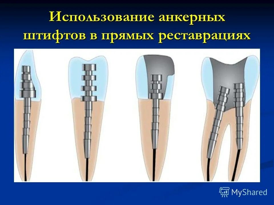 Как вкручивают штифт. Анкерный штифт под коронкой. классификация анкерных штифтов. анкерный штифт или стекловолоконный.