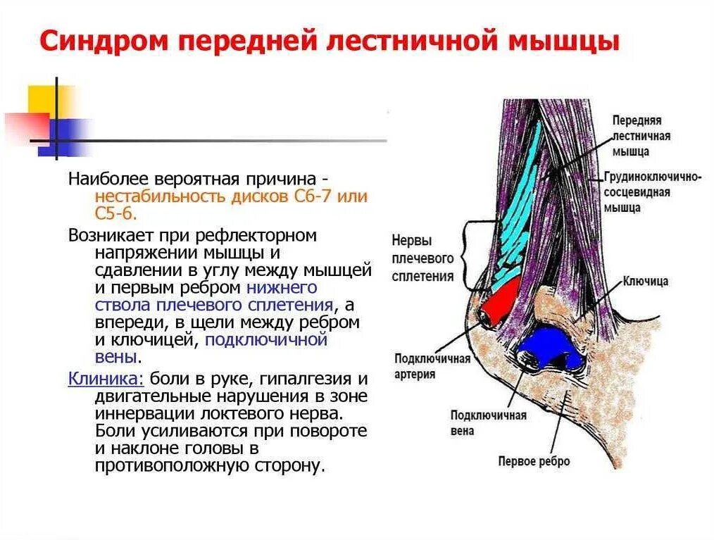 Синдромы мышц. Синдром передней лестничной мышцы. синдром передней лестничной мышцы неврология. синдром лестничной мышцы. синдром передних лестничных мышц.