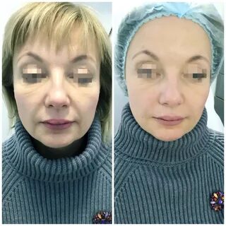 Пластика отзывы