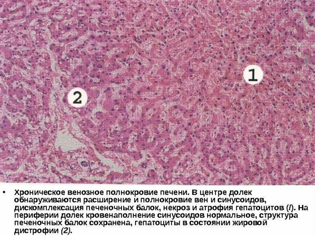 Хроническая венозная гиперемия. Острое венозное полнокровие легких, отек. Мускатная печень макропрепарат патанатомия. Мускатный цирроз печени микропрепарат. Мускатный цирроз печени микропрепарат.