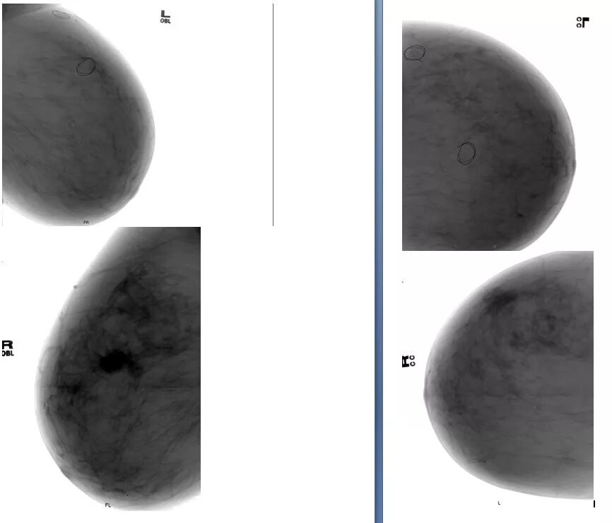 Маммография bi-rads 4. Маммография шкала bi-rads. Маммография молочных желез bi rads 4. Заключение маммографии bi-rads 4. Диффузная мастопатия bi rads 2