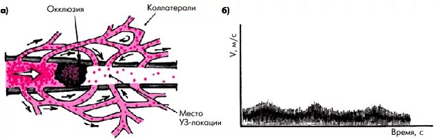 Развитые коллатерали. Коллатеральное кровообращение схема. Коллатеральный кровоток сердца. Коллатеральное кровообращение. Коллатеральное кровообращение схема.