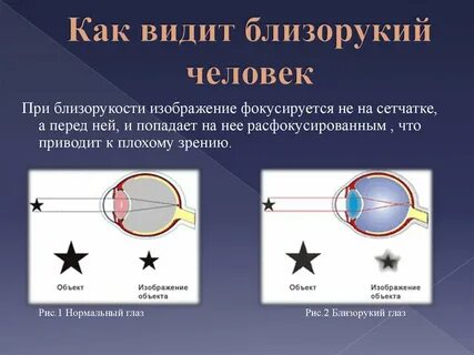 Как видит человек с миопией