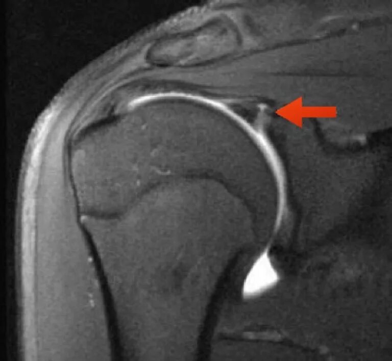 Плечевая губа суставная разрыв. Slap плечевого сустава мрт. Slap синдром плечевого сустава мрт. Слэп повреждение плечевого сустава. Слап разрыв плечевого сустава мрт.