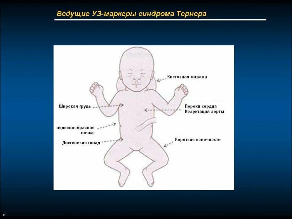 УЗИ маркеры хромосомных аномалий. УЗИ маркеры хромосомной патологии. Уз маркеры