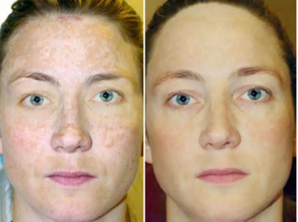 Лазерная шлифовка кожи цена skinlift ru. Фракционный фототермолиз со2. Фракционный термолиз век. Фракционный лазер (фототермолиз). ДОТ- омоложение (лазерная со2 шлифовка):.