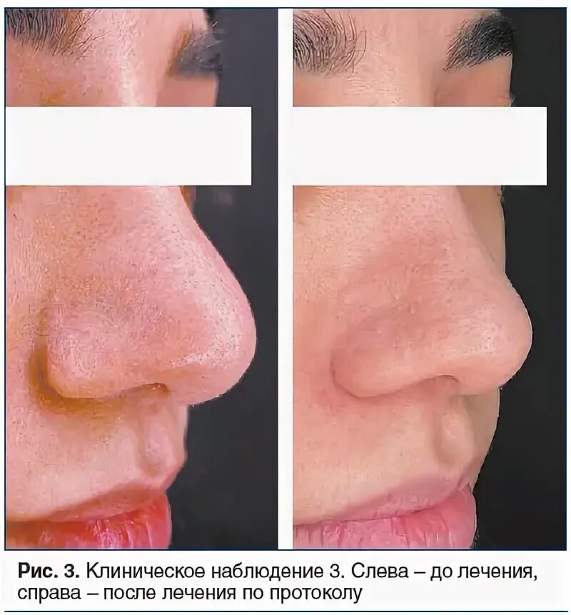Дипроспан ринопластика. Ринопластика сужение носа. Дипроспан для уменьшения носа.