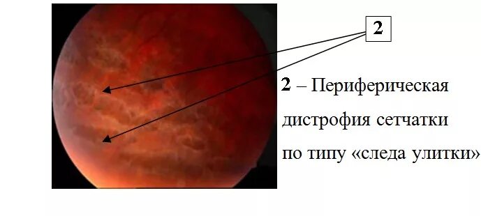 Периферические ретинальные дегенерации. Периферическая дистрофия сетчатки булыжная Мостовая. «Булыжная Мостовая» — дистрофия сетчатки глаза. Булыжная Мостовая дегенерация сетчатки. Витреоретинальная дегенерация сетчатки.