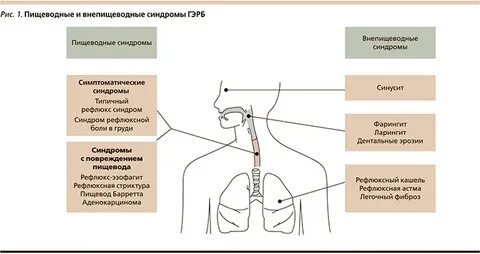 Кашель при эзофагите