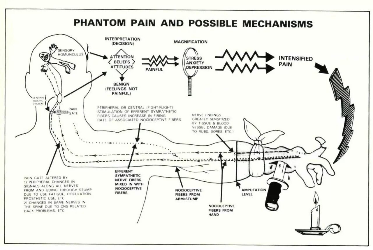 Фантомные боли патогенез. Фантомные боли механизм. Механизм развития фантомных болей. Phantom Limb Pain.