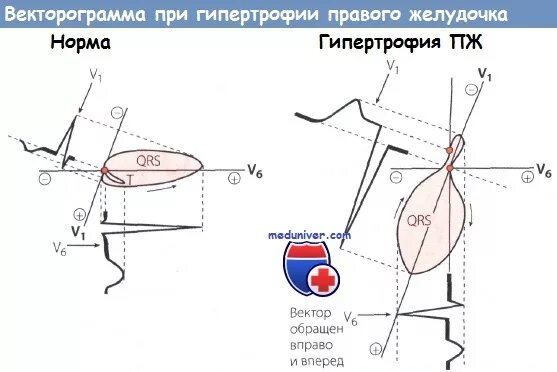 Гипертрофия правого желудочка. Векторограмма сердца. ЭКГ векторограмма. Перегрузка на ЭКГ. Поворот правым желудочком вперед