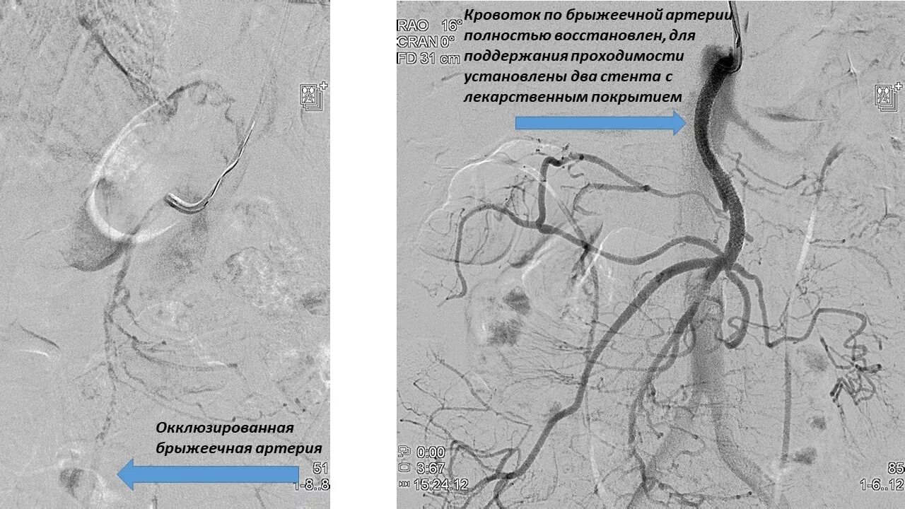 Тромбоз брыжеечной артерии. Баллонная ангиопластика верхней брыжеечной артерии. ангиопластика чревного ствола. стентирование брыжеечной артерии. стентирование верхней брыжеечной артерии.