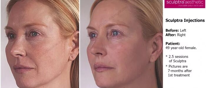 Филлер скульптра до и после. Sculptra полимолочная кислота. Sculptra коллаген. Скульптра sculptra в галактике. Sculptra филлер.